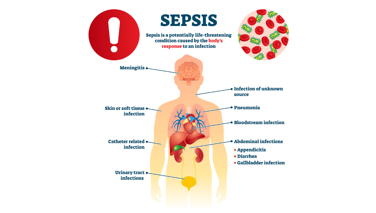 Sepsis Update: Antibiotics Timing